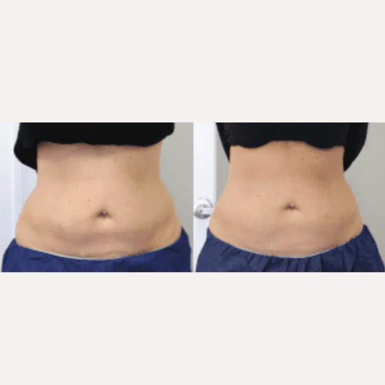 Before and after image showing the results of a tummy tuck procedure.