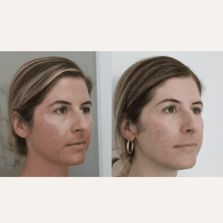Before and after plastic surgery comparison showcasing skin improvements.