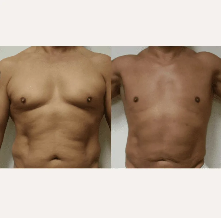 Before and after male chest liposuction results.