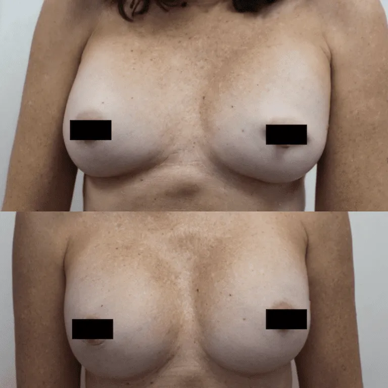 Before and after breast augmentation surgery results.