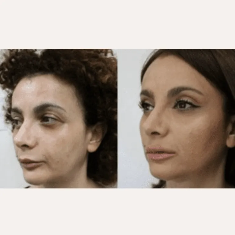 Before and after images of a woman showcasing results of cosmetic facial surgery.