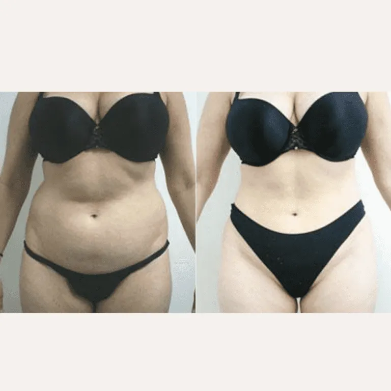 Before and after image of body contouring plastic surgery results.