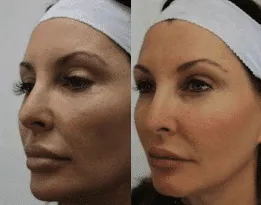 Before and after facelift transformation showcasing enhanced facial contours.