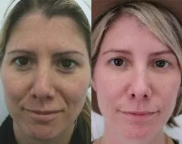 Before and after image of a woman's facial appearance following cosmetic surgery.