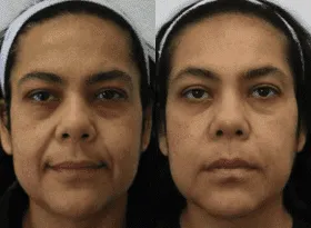 Before and after results of facial rejuvenation procedure.