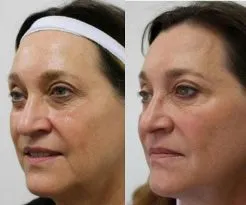 Before and after plastic surgery results on a middle-aged woman's face.