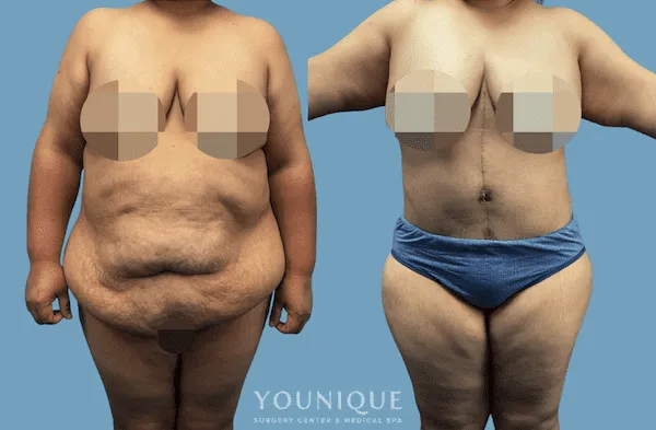 Before and after image of body contouring surgery at a plastic surgery center.