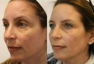 Before and after image showing facial rejuvenation results for a woman.