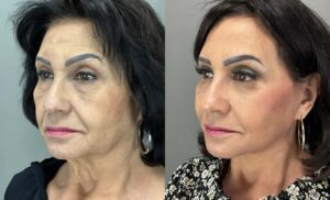 Before and after images of cosmetic surgery on a woman's face showing skin rejuvenation results.