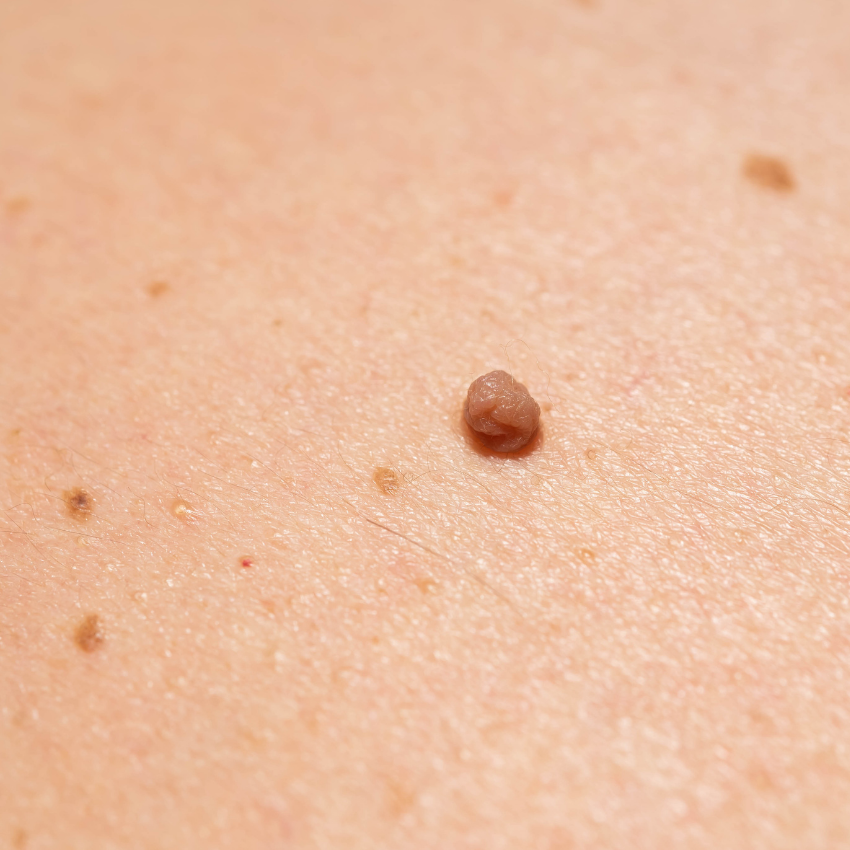 Woman receiving cosmetic injection in neck with precision.