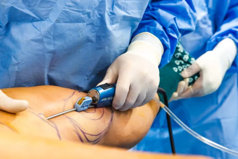 Plastic surgeon performing liposuction on a patient's arm in an operating room.