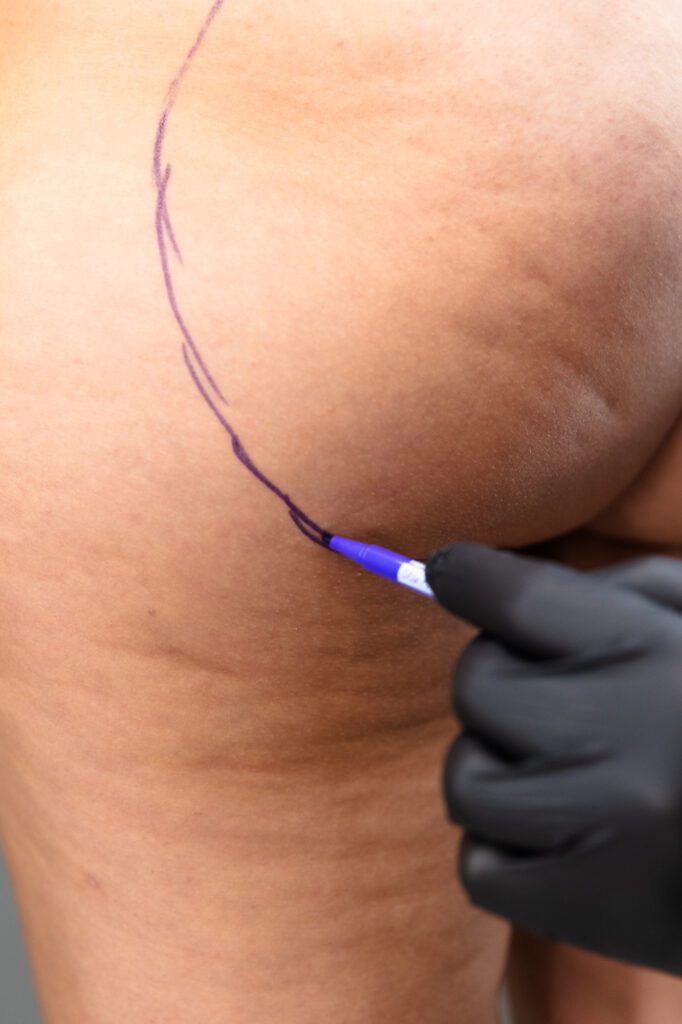 Plastic surgeon marking skin for cosmetic procedure.