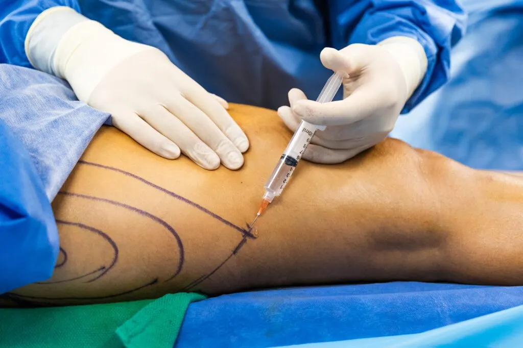 Surgeon performing liposuction procedure with syringe and marked guidelines on patient.