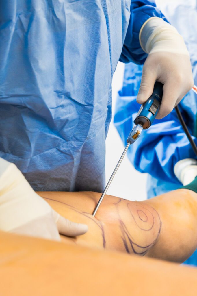 Surgeon performing liposuction with specialized tool.