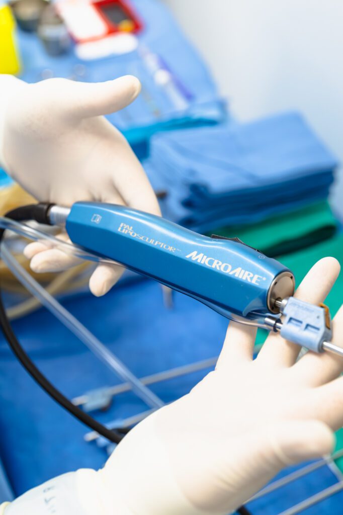 Gloved hand holding a MicroAire liposculptor tool in a surgical setting.