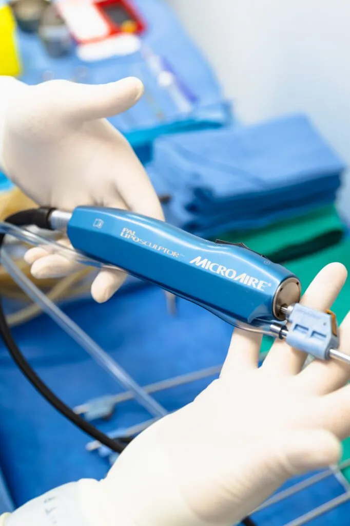 Gloved hand holding a MicroAire liposculptor tool in a surgical setting.