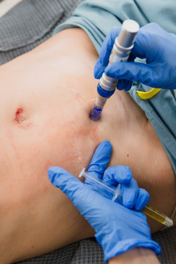 Person receiving minimally invasive cosmetic procedure on the abdomen at a plastic surgery center.