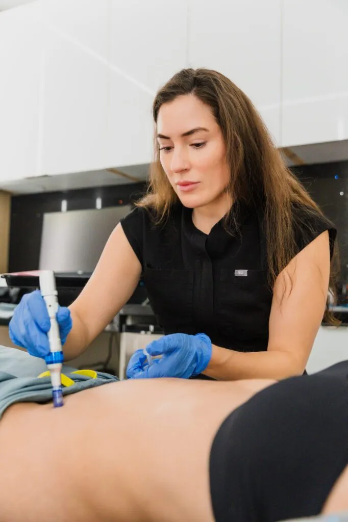 Cosmetic procedure being performed by a professional with a microneedling device.