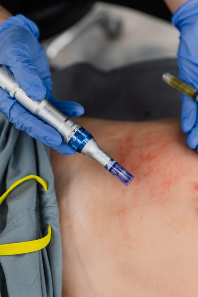 Professional performing microneedling procedure at a plastic surgery center.