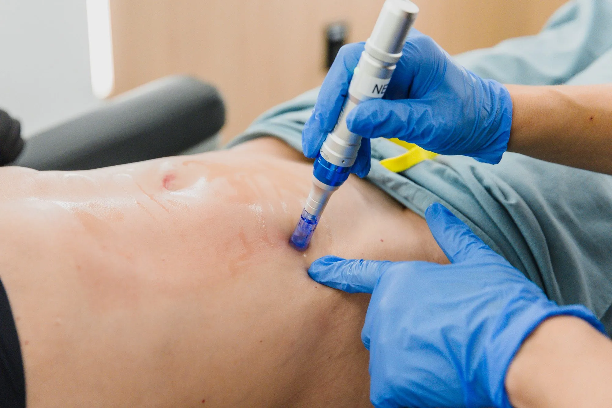 Person receiving microneedling treatment on the abdomen at a plastic surgery center.