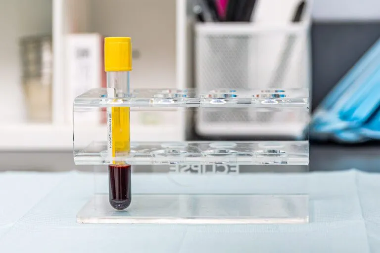 Blood sample tube in a lab test rack at a plastic surgery center.