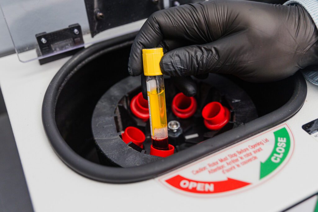 Gloved hand holding a vial in a medical centrifuge at a plastic surgery center.